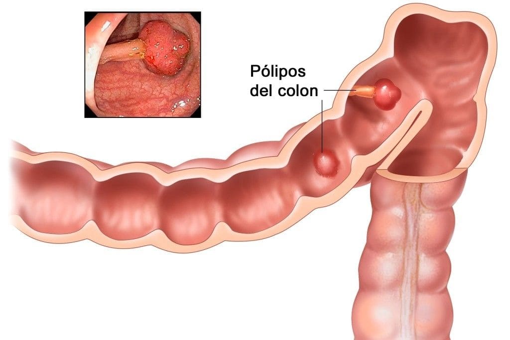 La Inteligencia Artificial en la Detección Temprana de Pólipos del Colon